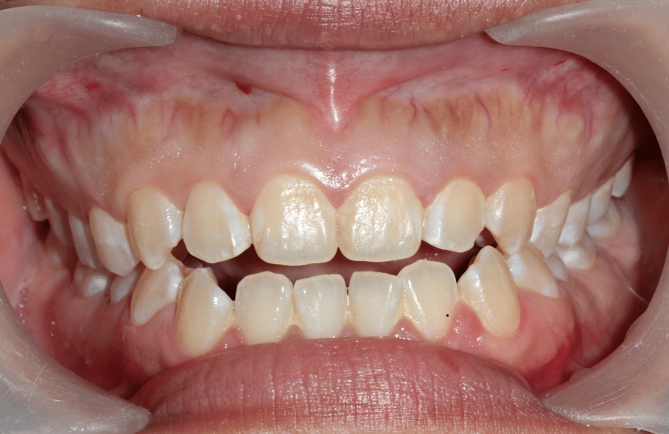 Smile transformation achieved with implant-retained dentures.